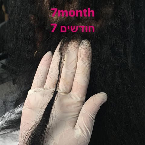 חידוש חותספות שיער